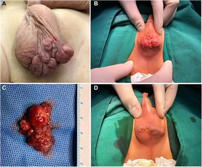 Congenital giant fibroepithelial polyp of the scrotum in an infant: the first case report from China